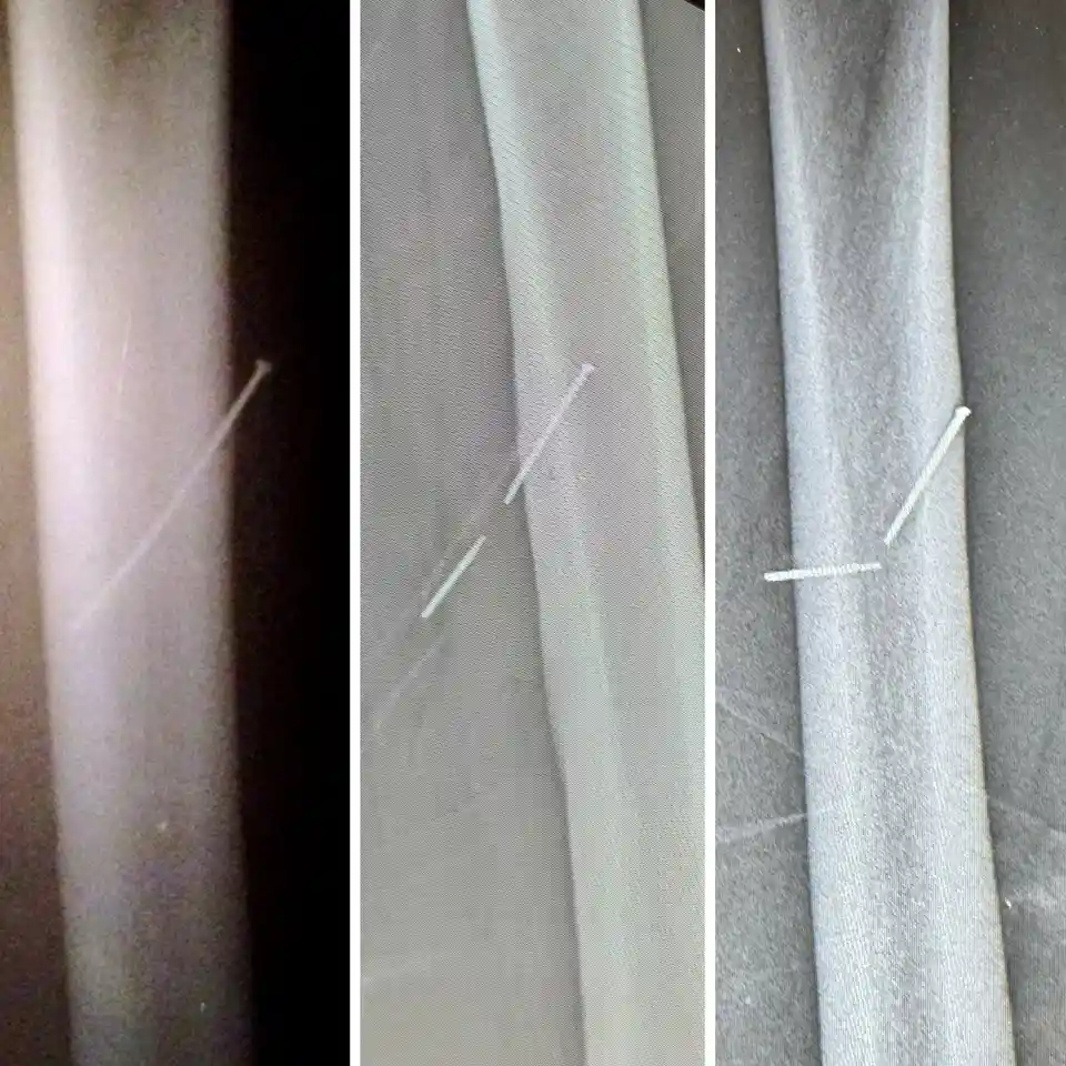 A triptych of close-up images shows a thin, white nail embedded in a person's arm, progressively more visible from left to…