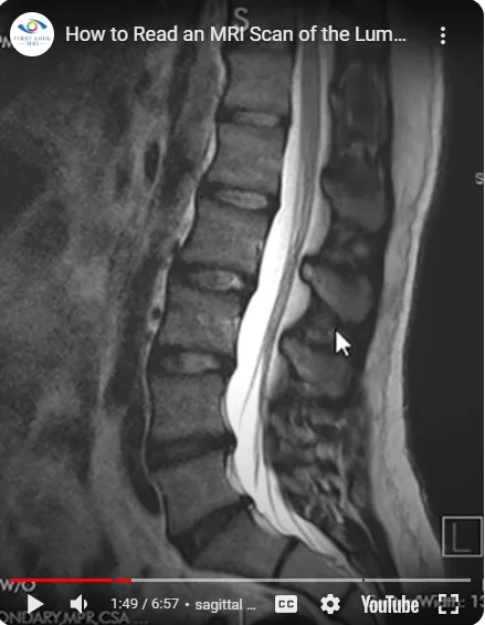 A grayscale sagittal MRI scan of the lumbar spine shows vertebral bodies, intervertebral discs, and spinal canal. A white…