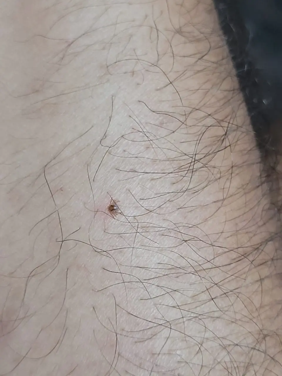 A close-up photo shows a small brown tick embedded in human skin, surrounded by dark hairs. The overlaid text reads 'i found…