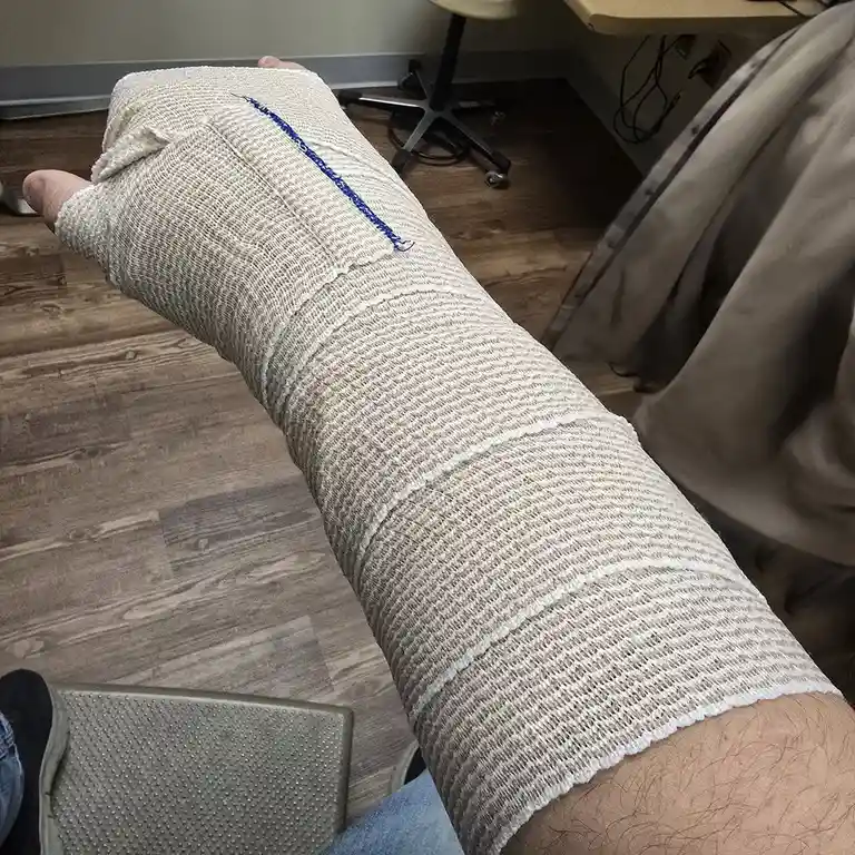 A person's arm is heavily wrapped in beige medical gauze, extending from the hand to the upper forearm, with a blue thread…