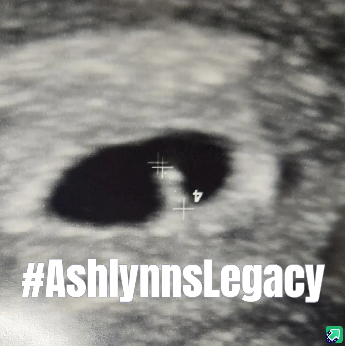 A grainy, black-and-white ultrasound image shows a dark, oval-shaped gestational sac with a small white '4' and crosshairs…