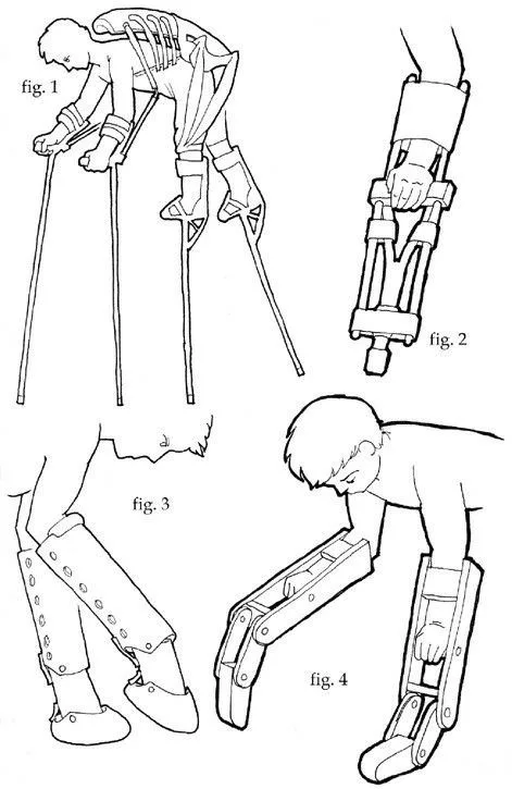 A black-and-white line drawing shows four labeled figures: a boy using crutches and leg braces (fig. 1), a close-up of a…