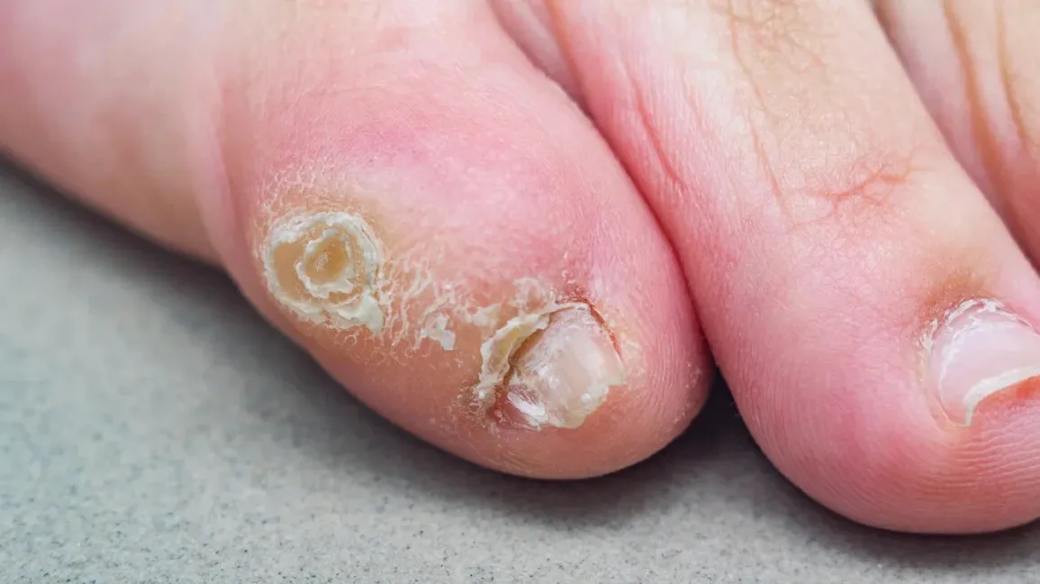 A close-up photo shows two toes with severely damaged, peeling, and discolored toenails, surrounded by inflamed skin. The…