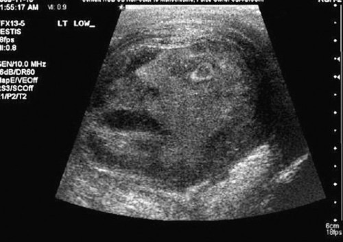 A grayscale ultrasound image shows a developing fetus with a visible face, mouth, and eyes. Overlaid text in the upper left…