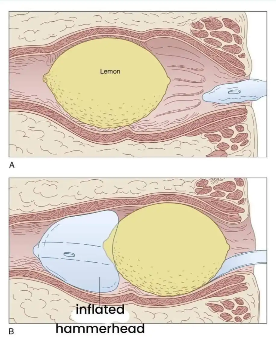 The image displays two medical-style diagrams labeled A and B. Diagram A shows a yellow lemon labeled 'Lemon' inside a body…