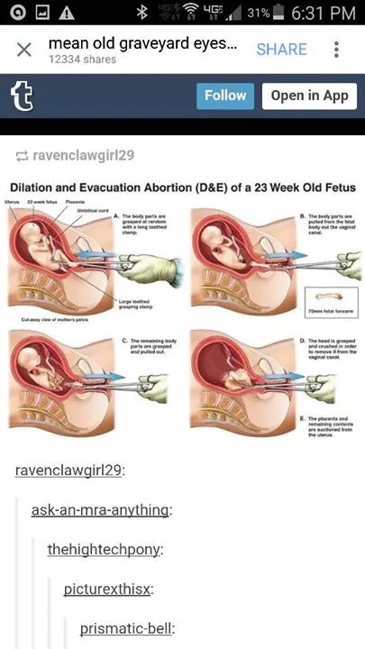 A medical diagram showing the five-step procedure for a Dilation and Evacuation (D&E) abortion of a 23-week-old fetus, with…