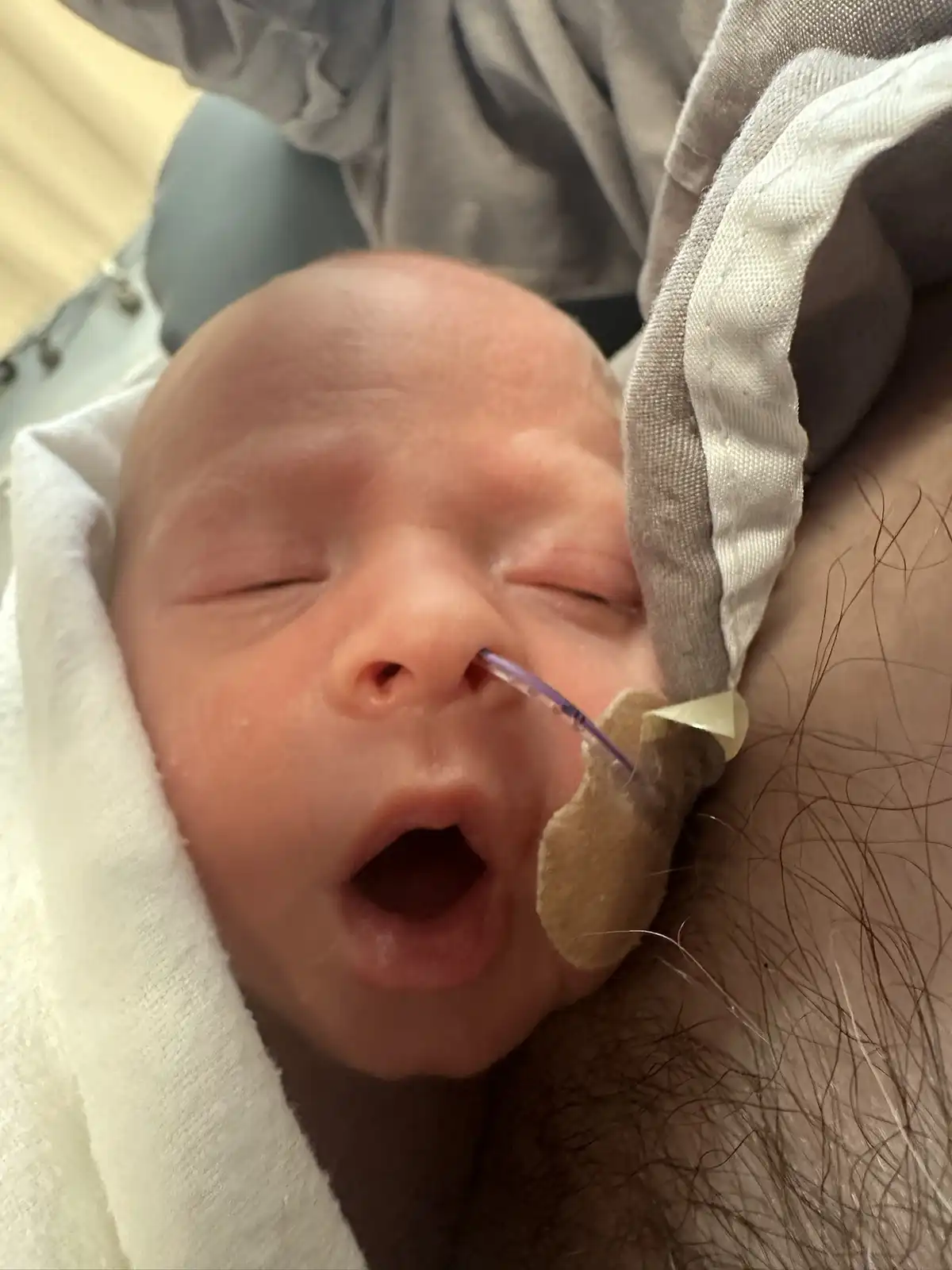 A close-up photo of a sleeping newborn baby wrapped in a white blanket, with a small medical tube taped to their nose. The…