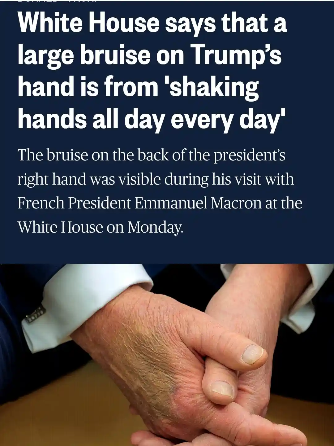 The image shows a close-up of two hands clasped together, one hand visibly displaying a large bruise on its back. The…