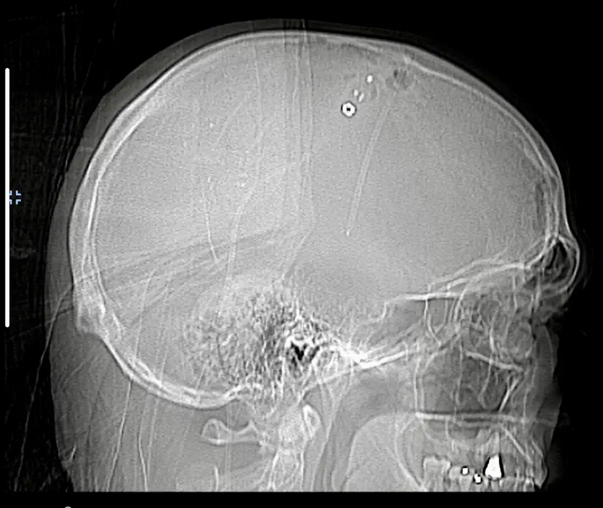 A grayscale medical CT scan image of a human skull from a side profile, showing the skull bones, brain tissue, and visible…
