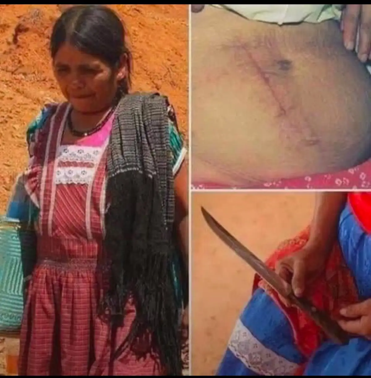 A three-panel image collage shows a woman in traditional clothing looking emotional, a close-up of a stomach with a scar…