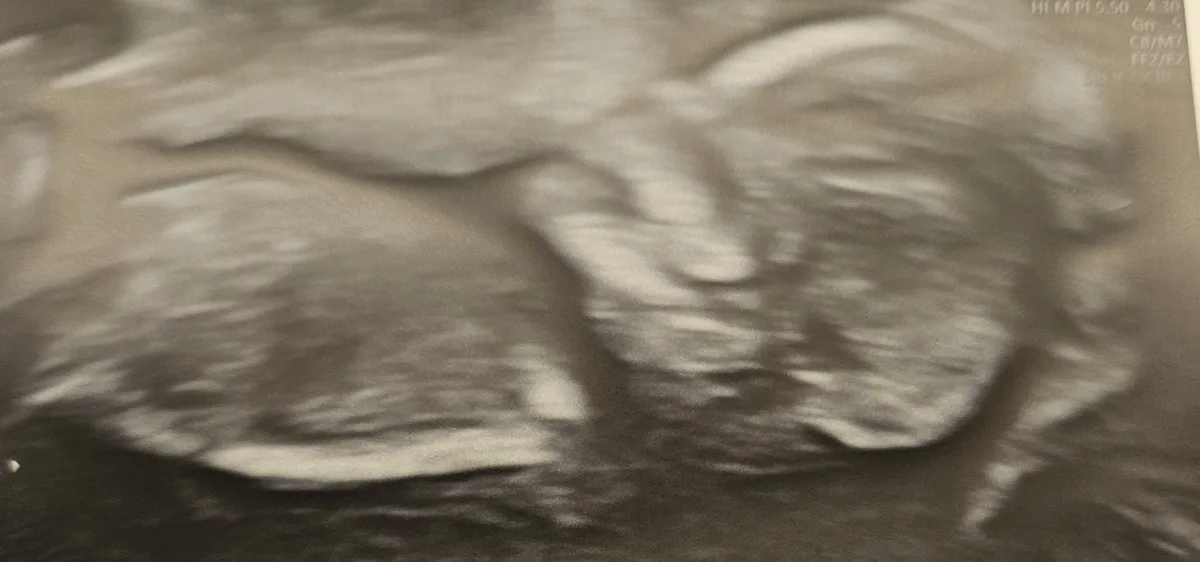 A blurry, grayscale ultrasound image shows two distinct, rounded shapes that resemble faces, with one appearing to have a…
