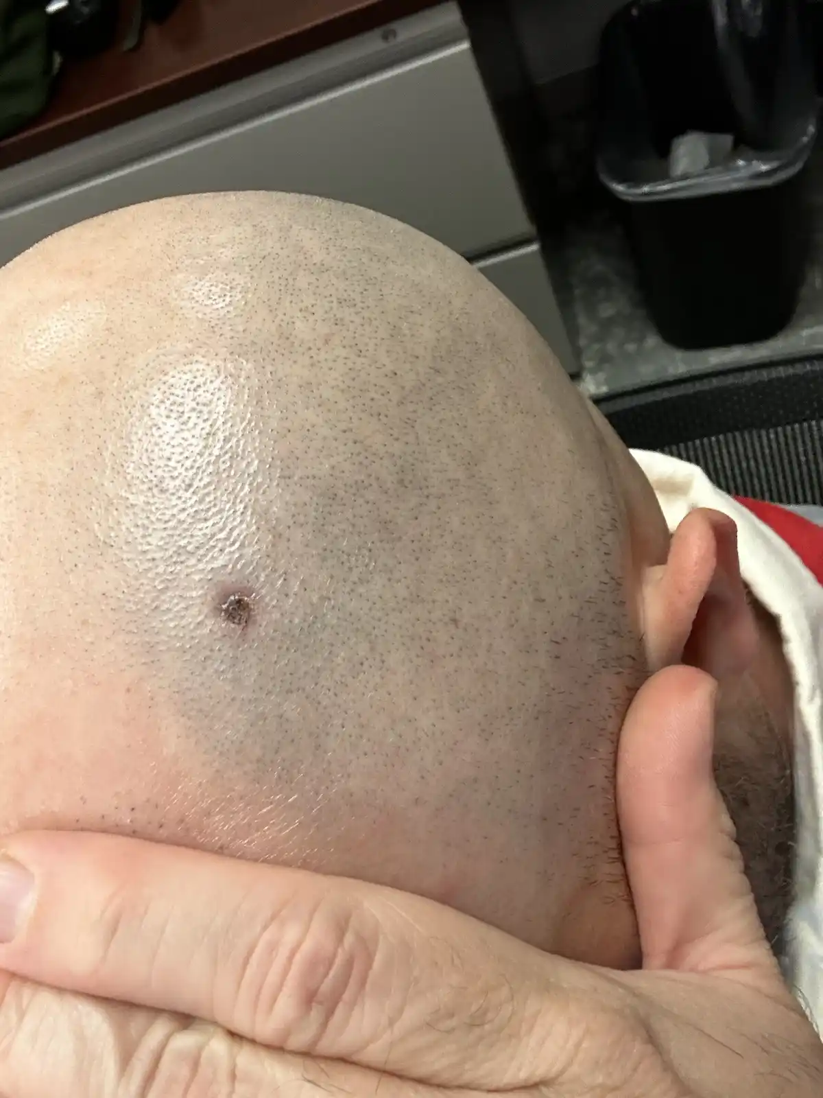 A close-up photo shows a person's bald scalp with a small, dark, raised bump near the center. A hand is holding the side of…