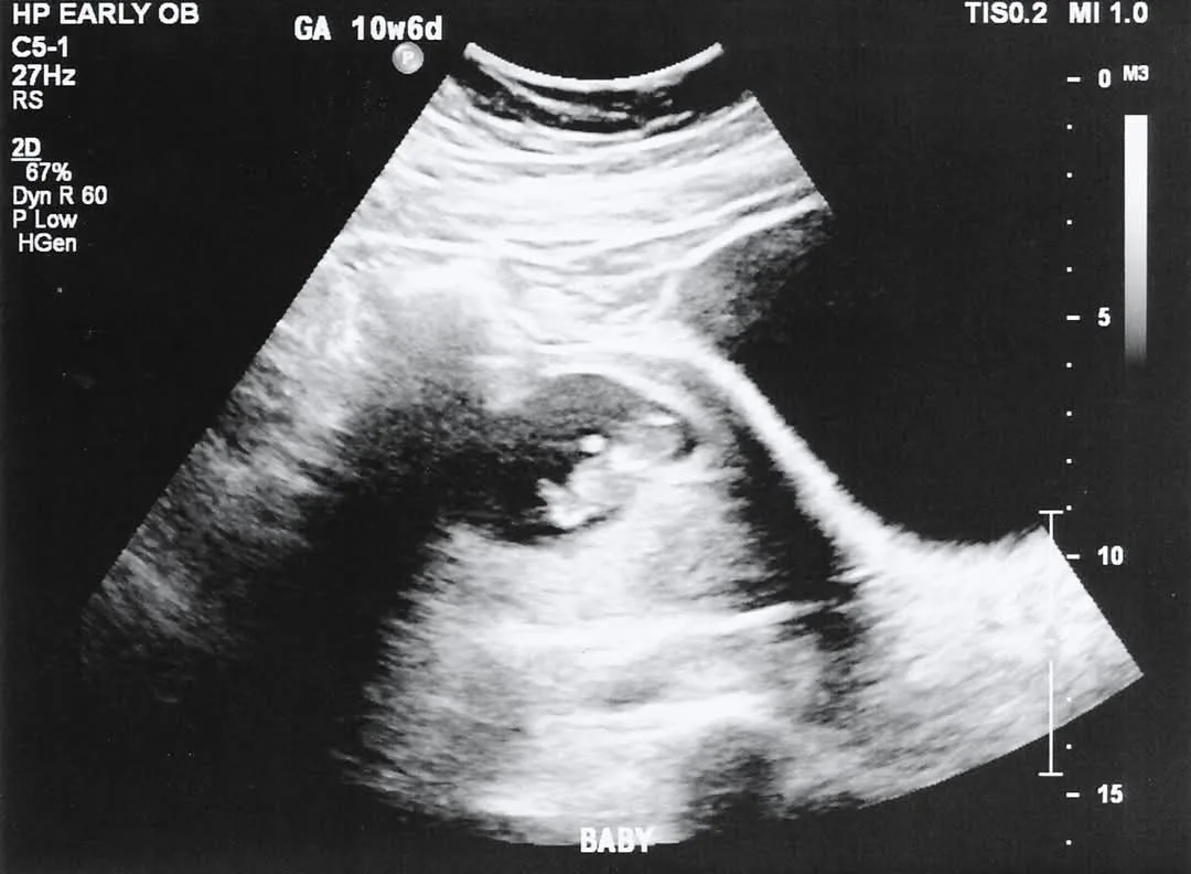 A grayscale ultrasound image showing a developing fetus at 10 weeks and 6 days gestation, with medical scan data visible…