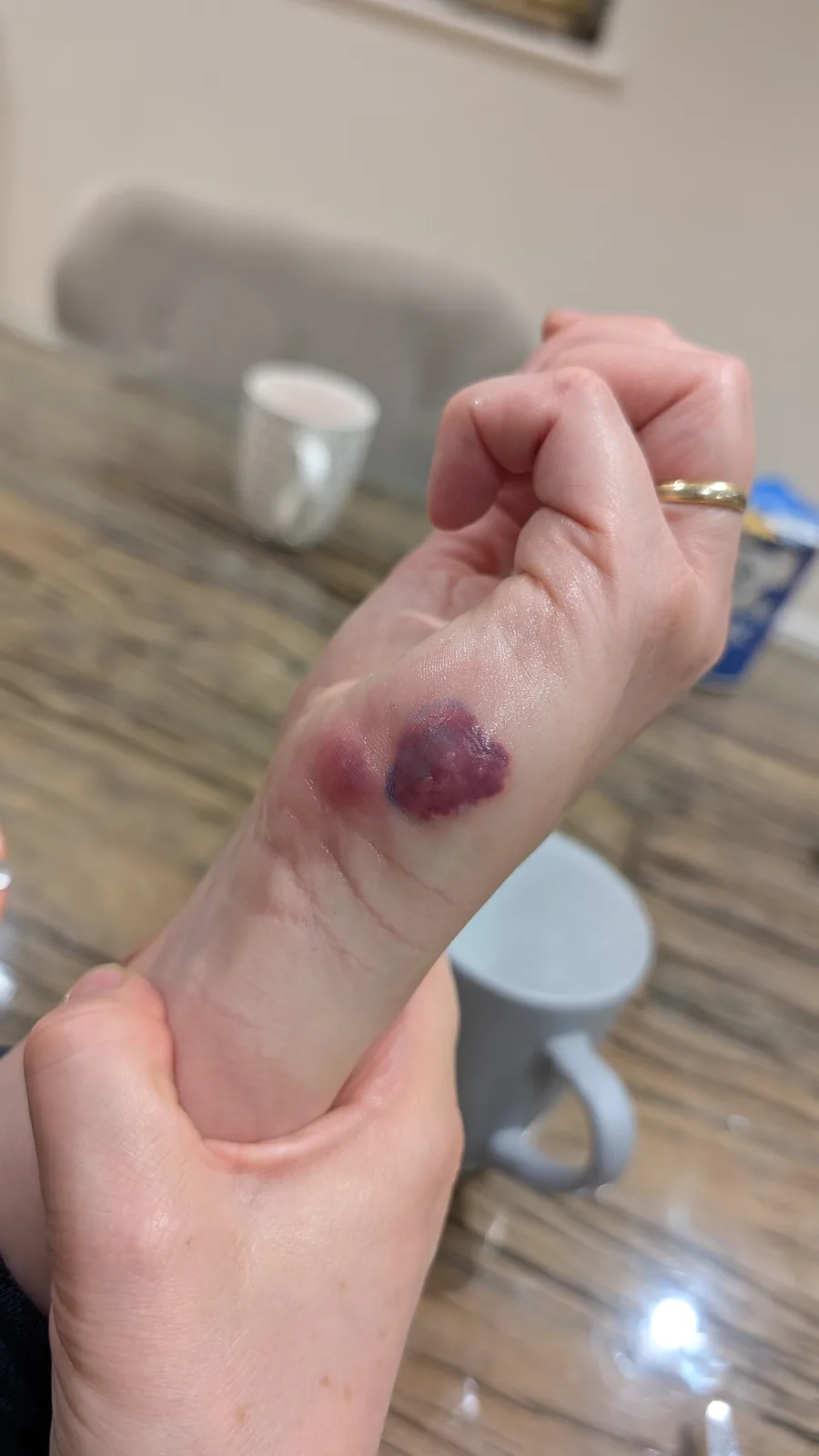 A close-up photo shows a person's left wrist with a large, dark purple bruise and some redness, likely from a fall. The…