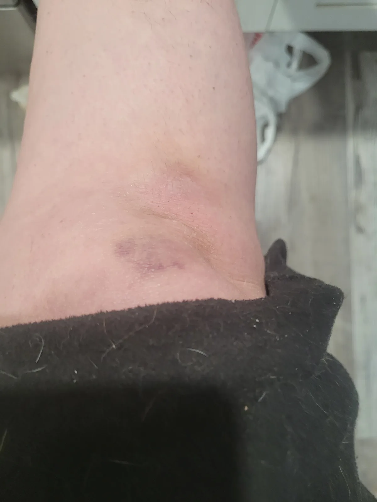 A close-up photo shows a person's forearm with a small, purplish bruise near the wrist, partially covered by a dark sleeve…