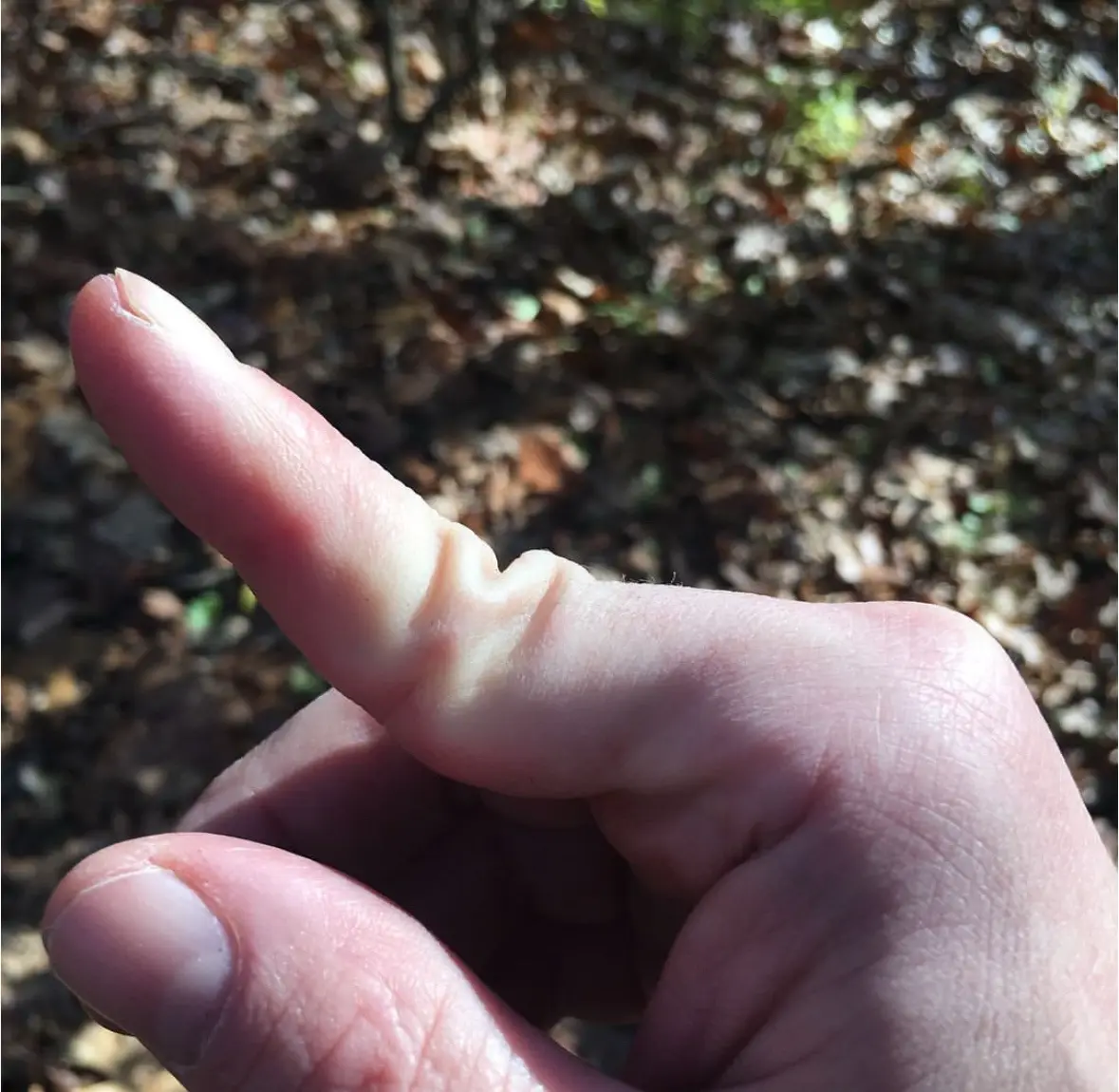 A close-up photo shows a person's finger, likely the index finger, pointing forward with a noticeable swelling or bump near…