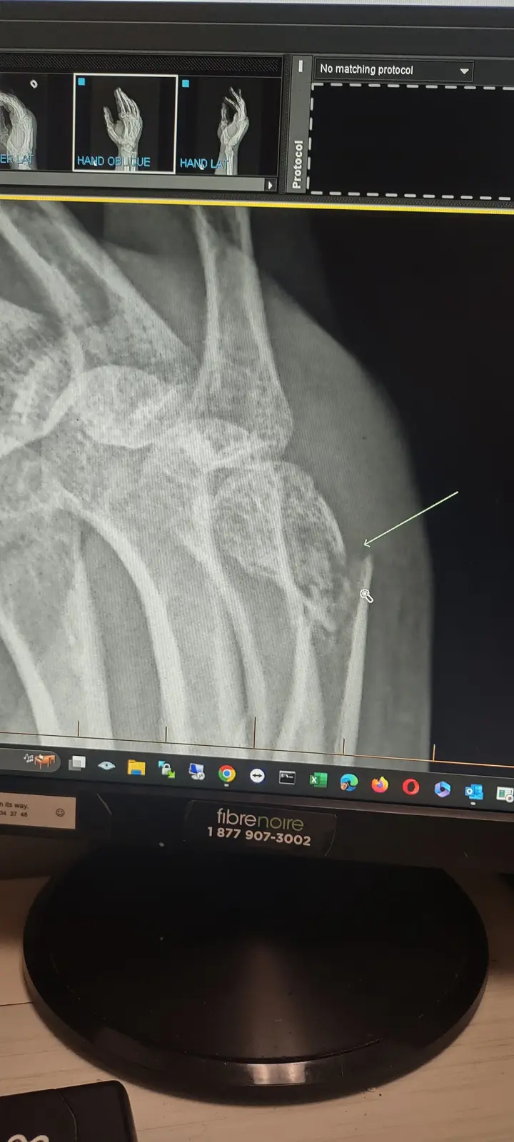 A computer monitor displays a medical X-ray image of a hand and wrist, with a green arrow pointing to a bone. The screen's…