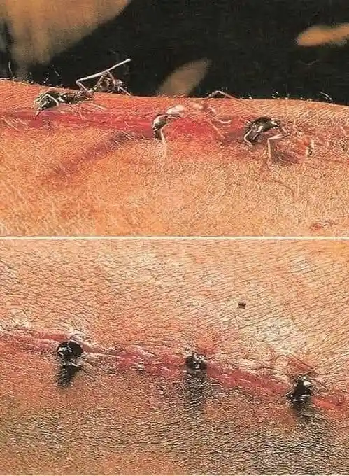 The image shows two close-up photos of a human wound with stitches. In the top photo, several ants are crawling on the open…