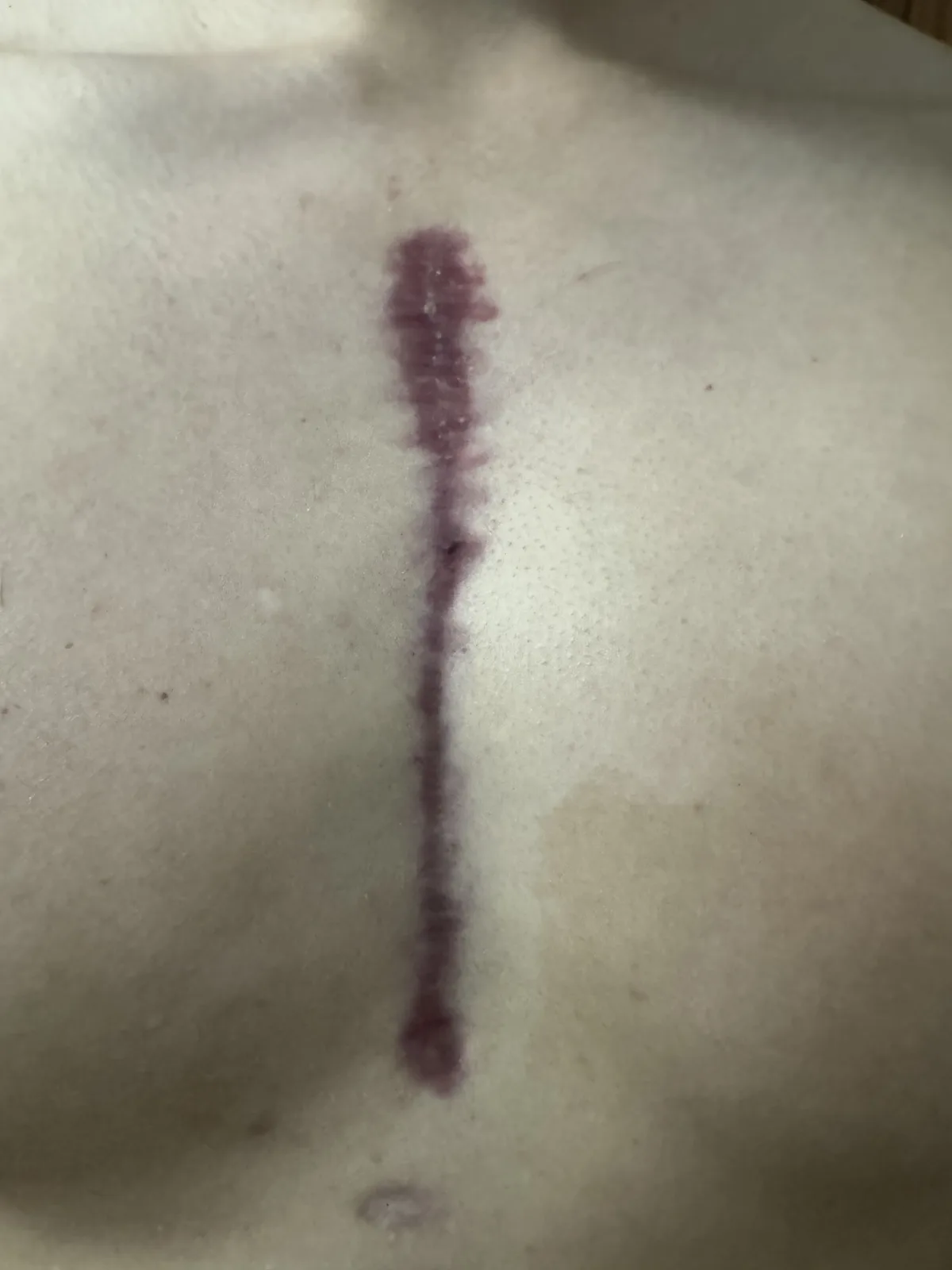 A close-up photo shows a vertical, purplish bruise on pale skin, resembling a long, thin mark. The overlaid text reads 'i…