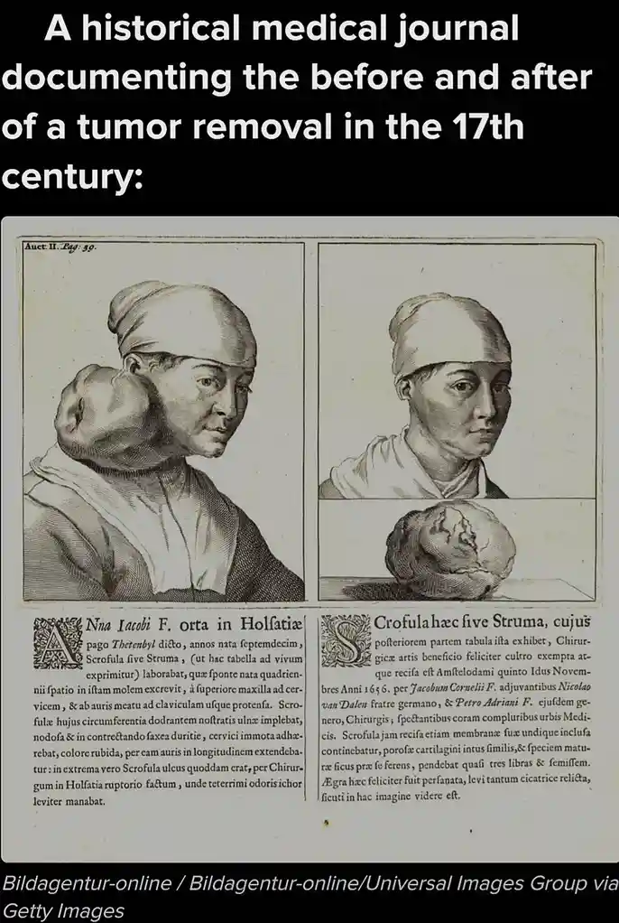 The image displays a historical medical journal page from the 17th century, featuring two side-by-side engravings: one of a…