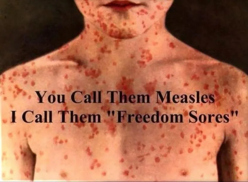A person's upper torso and neck are covered in red measles rash. Overlaid text reads: 'You Call Them Measles I Call Them…