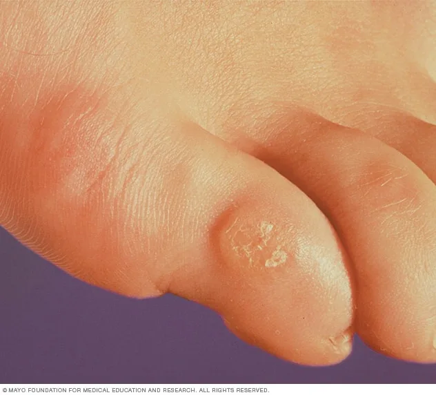 a close-up medical photo of a human toe with visible redness and peeling skin, overlaid with the text 'my toe is so sore…