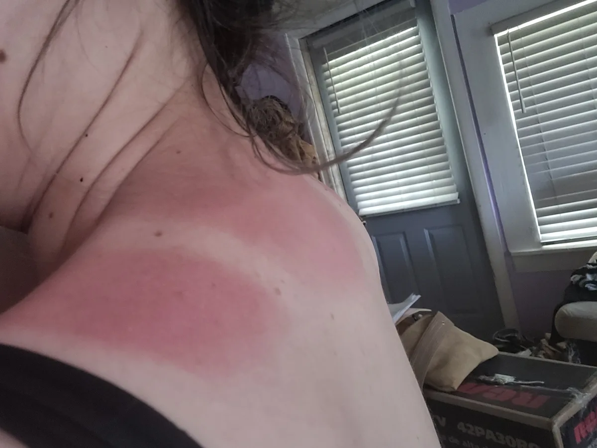 Once Upon a Time: Learning the Hard Way About Sunburn