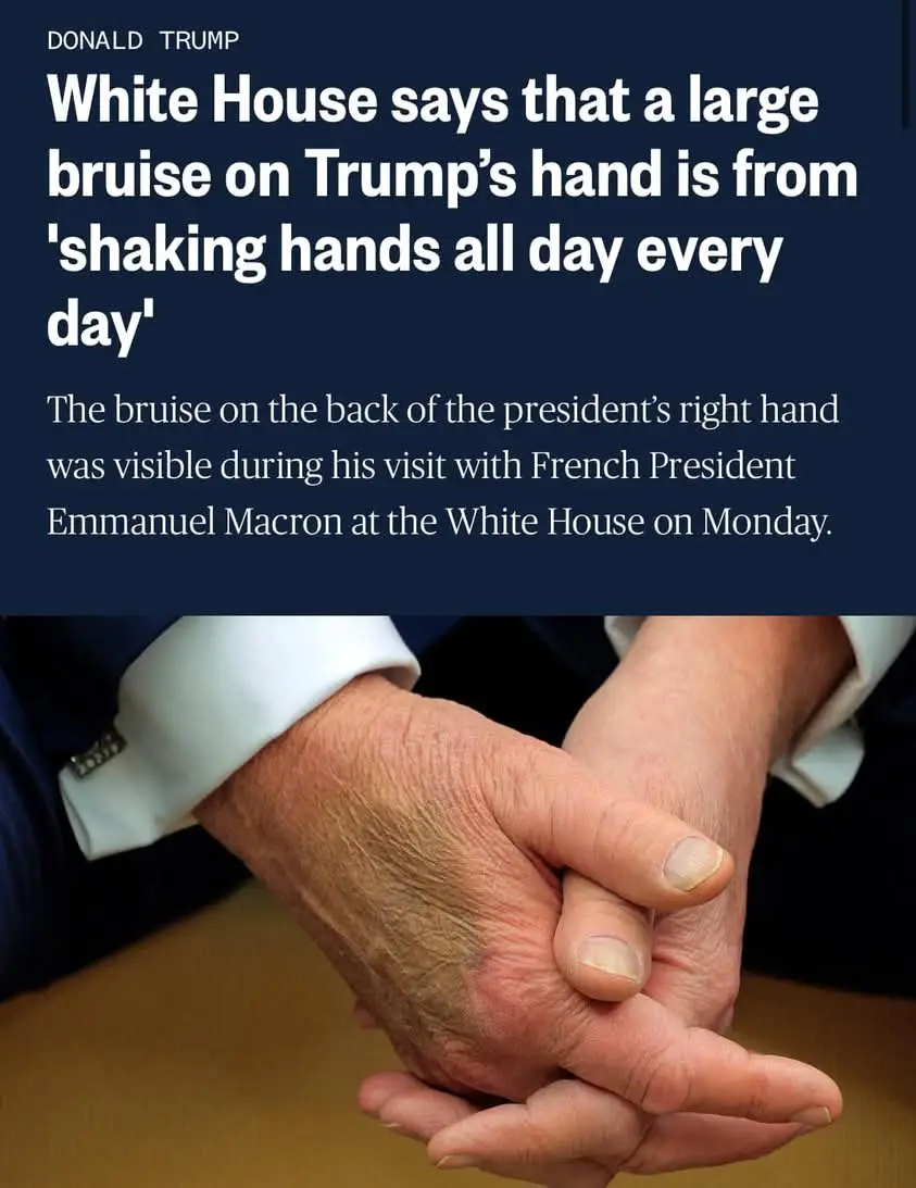 The image shows a close-up of Donald Trump's hands clasped together, with a visible bruise on the back of his right hand…