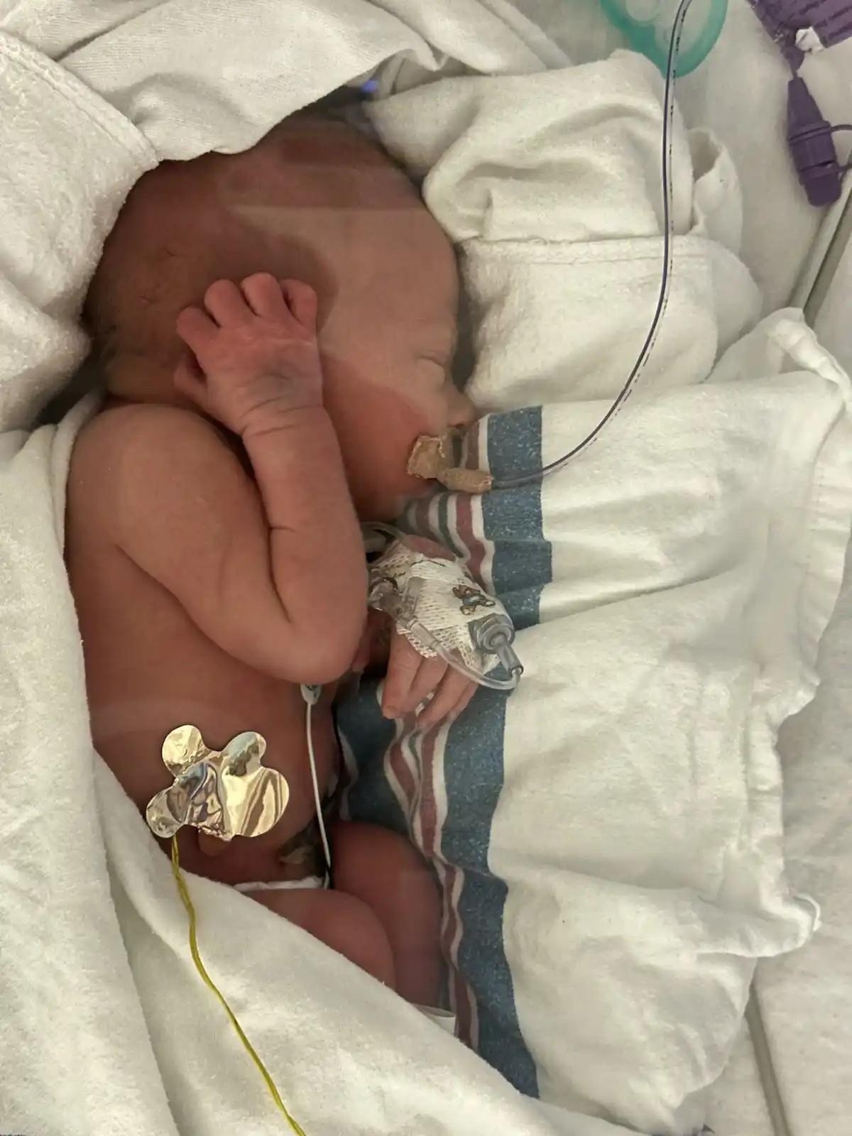 A newborn baby, wrapped in white blankets and lying in a hospital bed, has medical equipment attached including a heart…