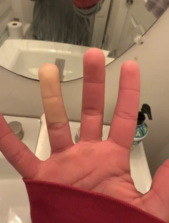 A close-up photo shows a person's open palm with fingers spread, the index finger noticeably paler than the others…
