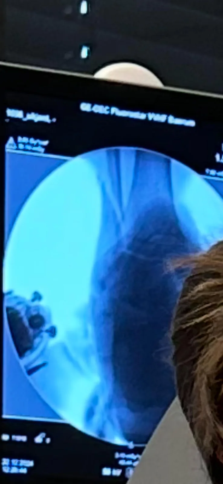 A person with brown hair is looking at a medical monitor displaying a blue-tinted fluoroscopy image of a human torso, likely…