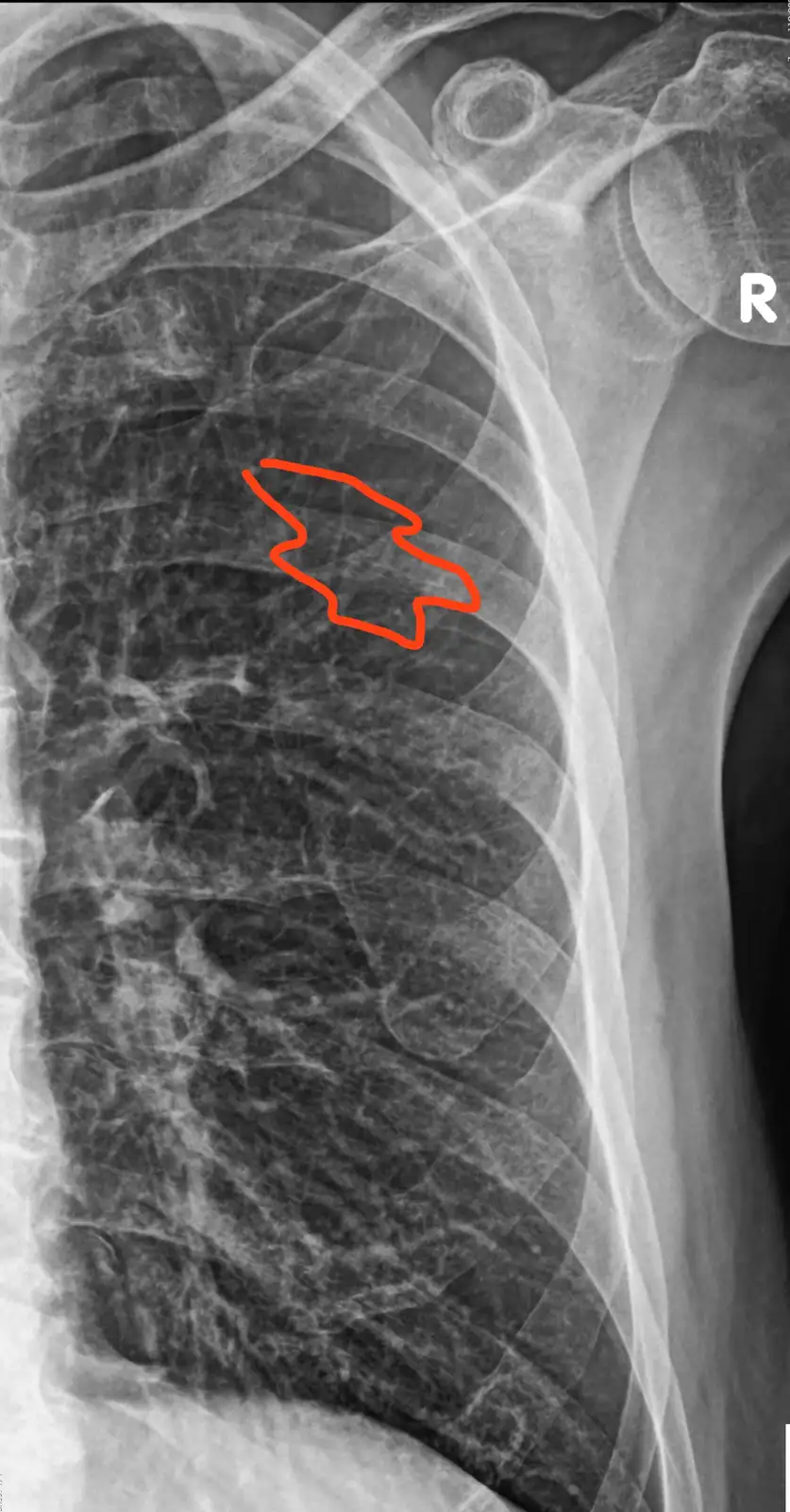 this is a chest x-ray image showing the rib cage and lungs, with a red hand-drawn outline highlighting a star-shaped area in…
