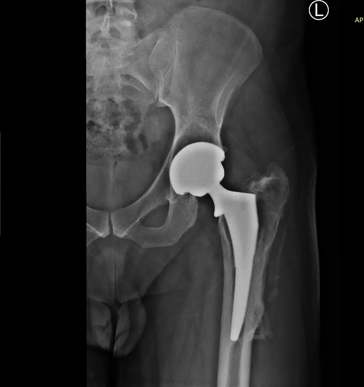 An x-ray image shows a left hip with a visible artificial hip replacement implant, including a metal stem and a ceramic or…