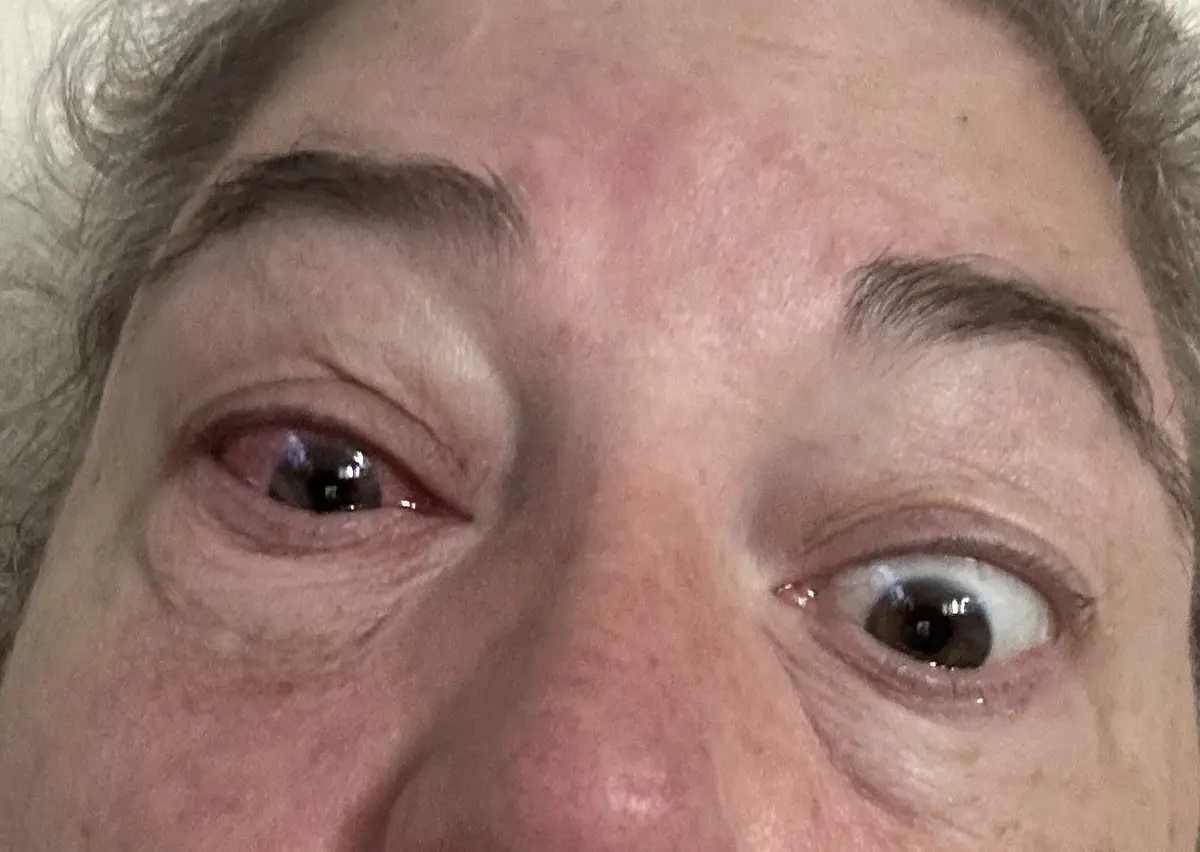 A close-up photo of a person's face showing one eye wide open and the other eye squinted shut, with visible wrinkles and…