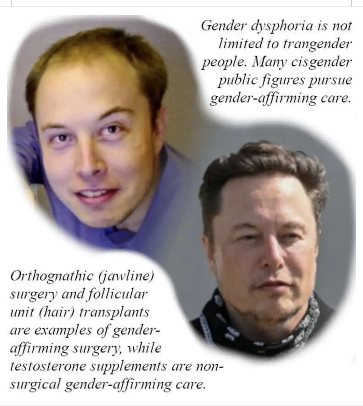 The image displays two photos of Elon Musk: one younger with a receding hairline and one older with a fuller head of hair…
