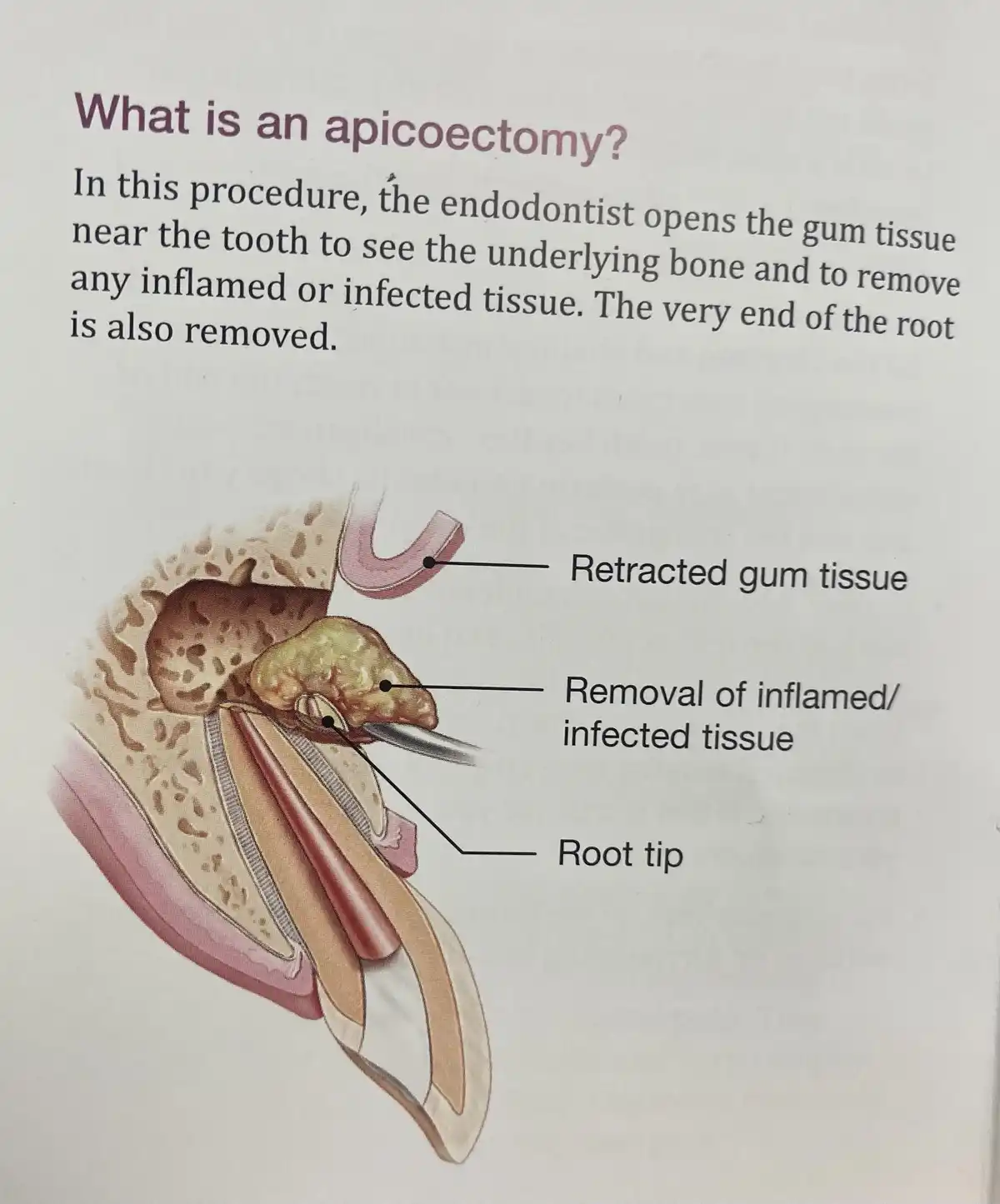An educational medical illustration shows a cross-section of a tooth with gum tissue retracted, revealing inflamed tissue…