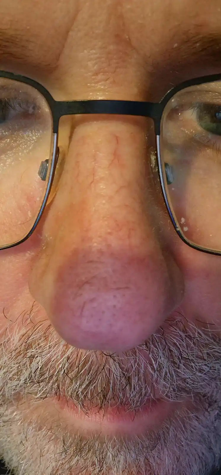 A close-up photo shows the tip of a man's nose, framed by his black-rimmed glasses and a graying beard. The nose is visibly…