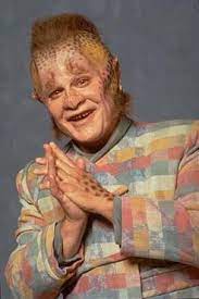 a man with heavily textured, patchy skin and a wide, toothy grin, wearing a colorful patchwork jacket, has his hands clasped…