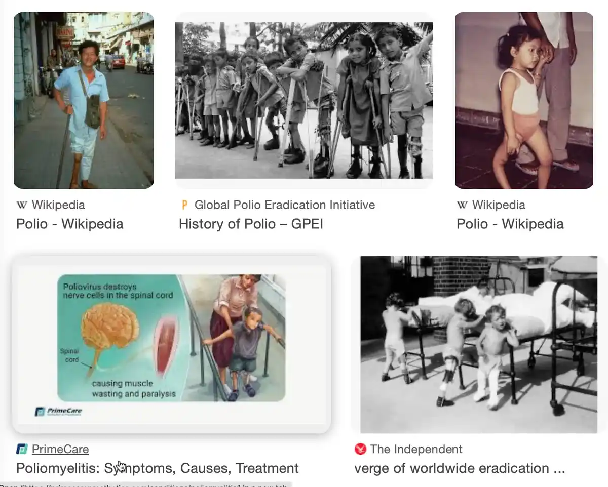A collage of five images showing historical and medical depictions of polio's effects: a man with a leg brace on a street, a…