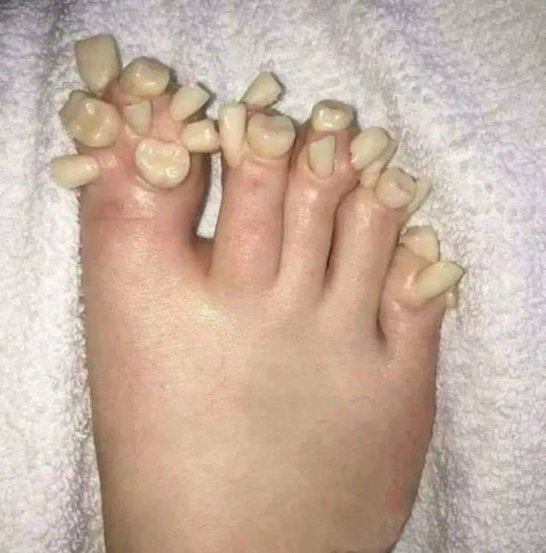A close-up photo shows a human foot with unnaturally long, thick, off-white toenails that resemble human teeth, resting on a…