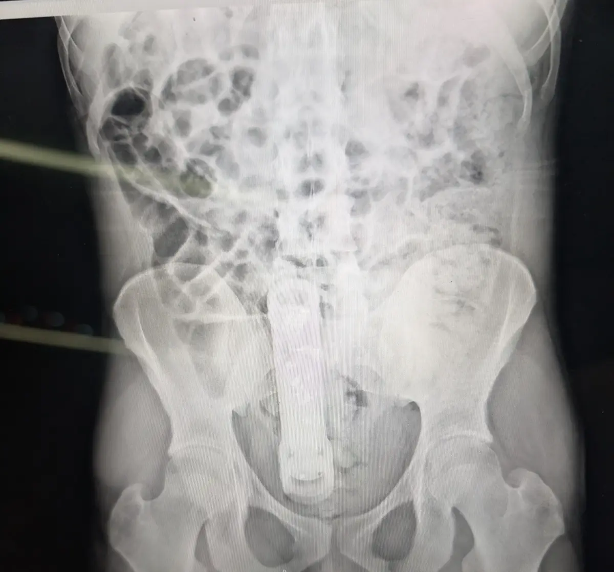 An x-ray image of a human torso and pelvis, showing bones and internal organs, with a long, cylindrical object inserted…