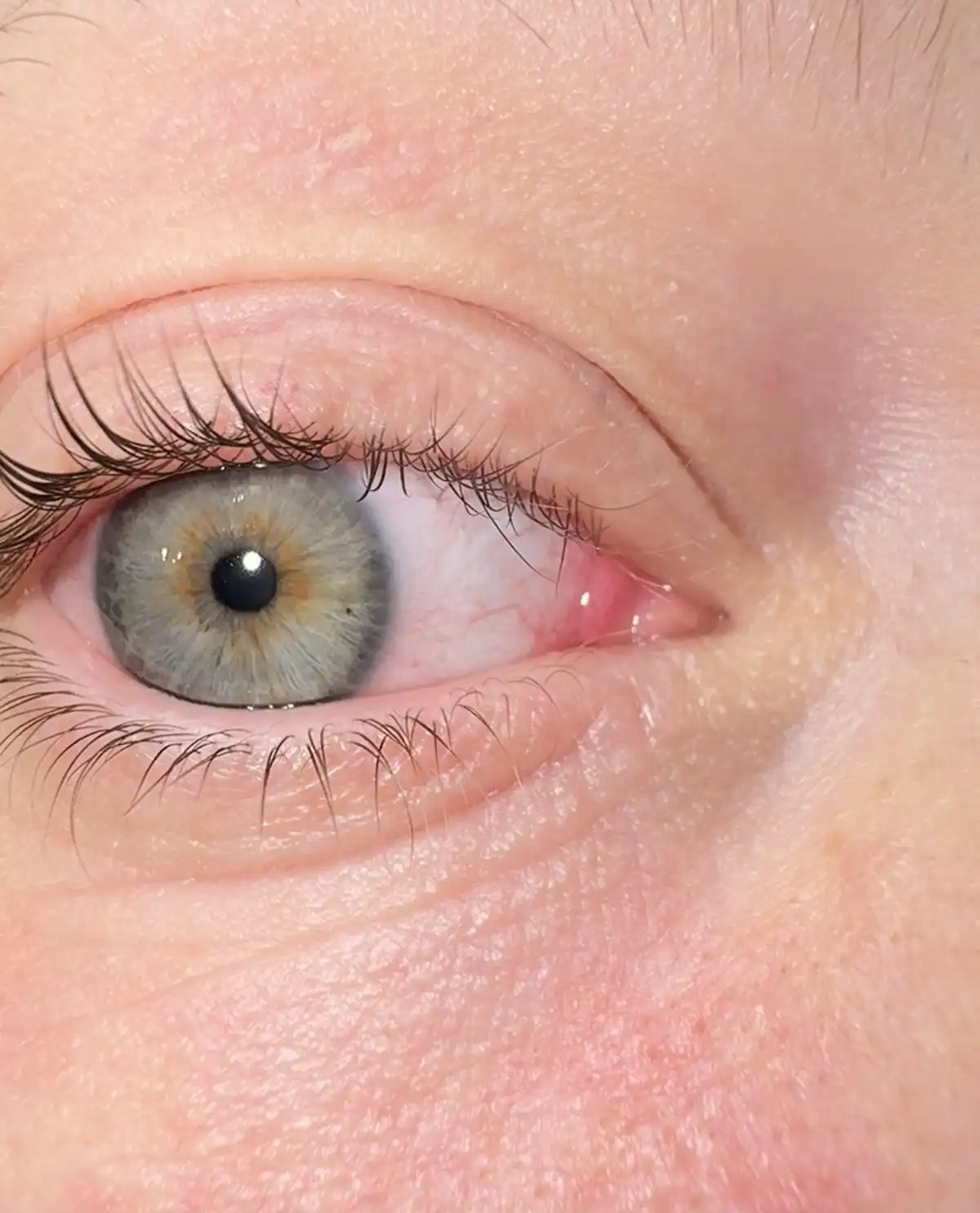 A close-up photo of a human eye with a grayish iris and visible redness in the inner corner of the eyelid. The overlaid text…