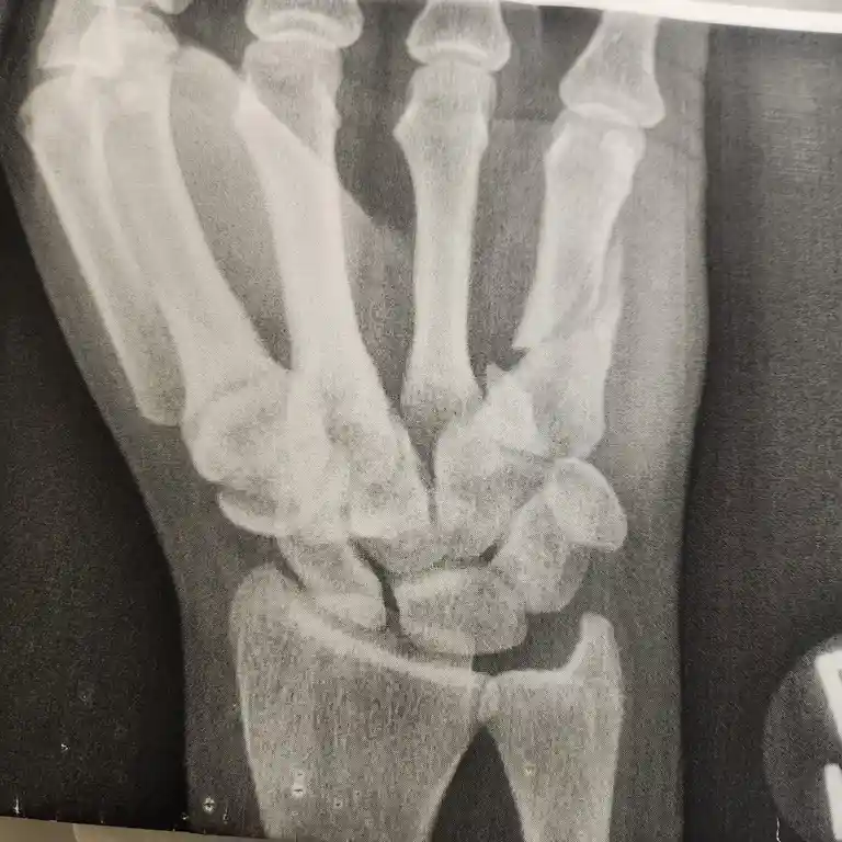 A black-and-white X-ray image shows a human hand and wrist with visible bones, overlaid with the text 'i have a broken…