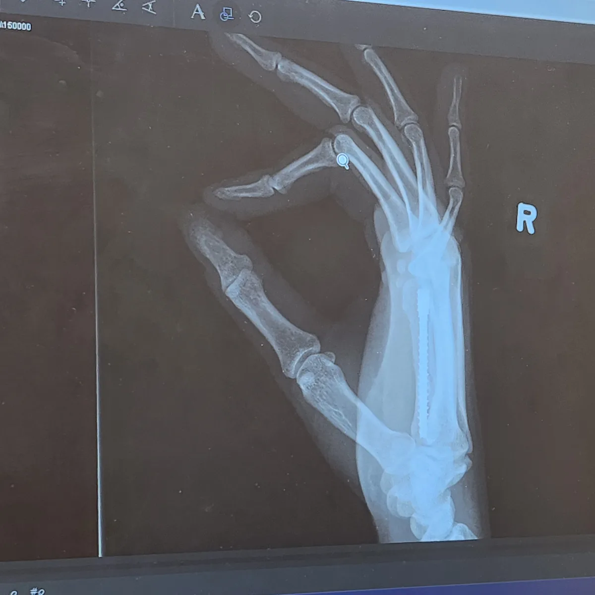 An x-ray image of a right hand and wrist, marked with an 'R', shows a metal rod inserted into the forearm and a visible…