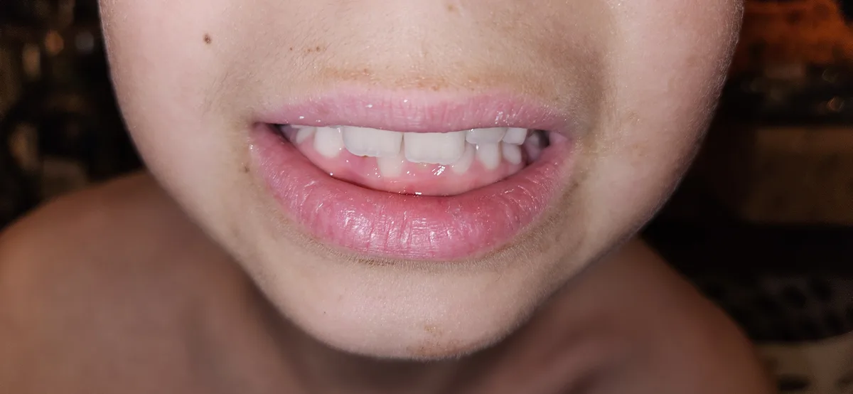 A close-up photo of a person's mouth showing their teeth and lips, with visible dark stains or discoloration on the skin…