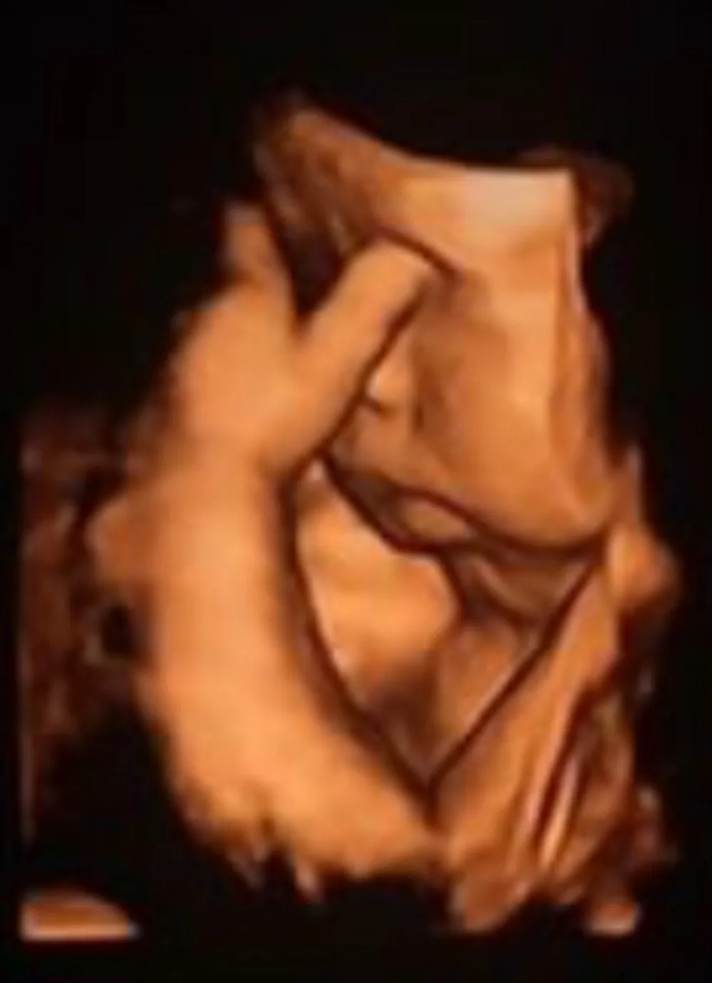 A blurry 3D ultrasound image shows a fetus with one hand raised to its face, resembling a thoughtful or contemplative pose…