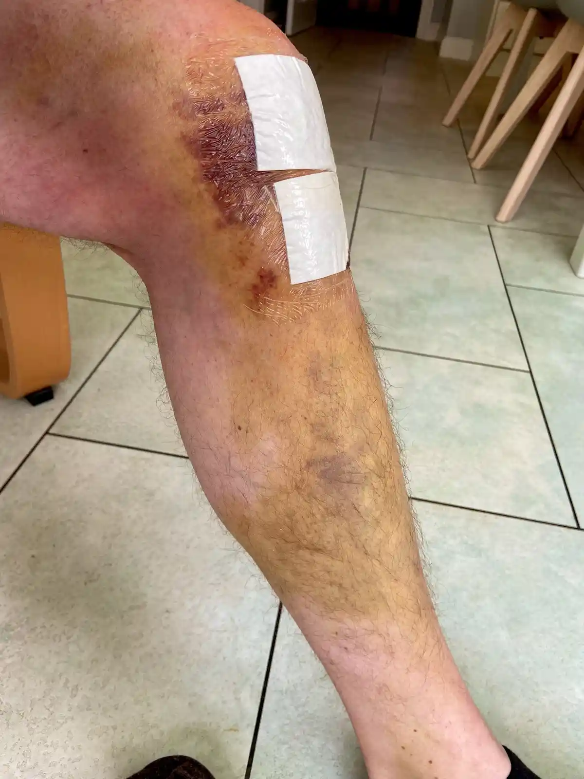 Surgery Update: Progress Report